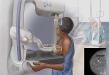 Detectados 6.130 nuevos casos de cáncer en Baleares durante 2021